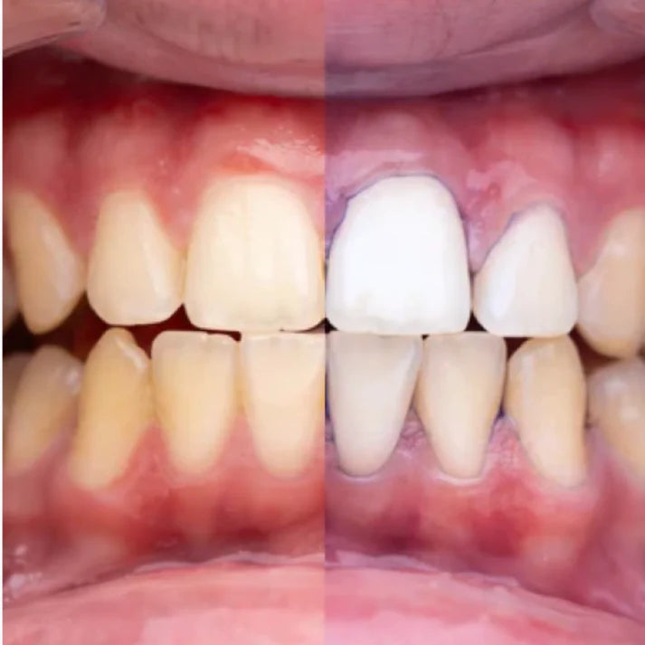 Blanqueador Dental Morado V34